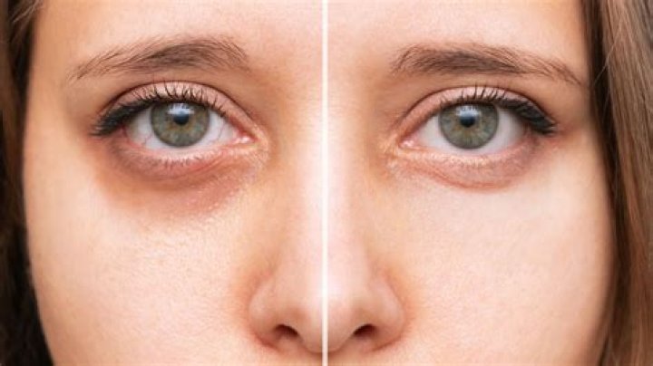 Botox Before and After Eyes: A Comprehensive Guide